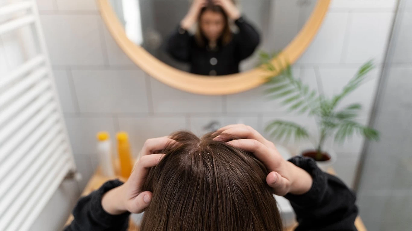 Stavite seboroični dermatitis pod kontrolu